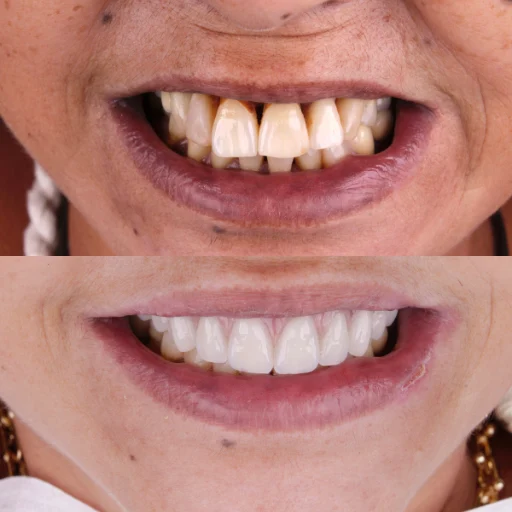 Carvalho e Marino antes e depois (1)