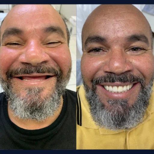 Carvalho e Marino antes e depois (2)