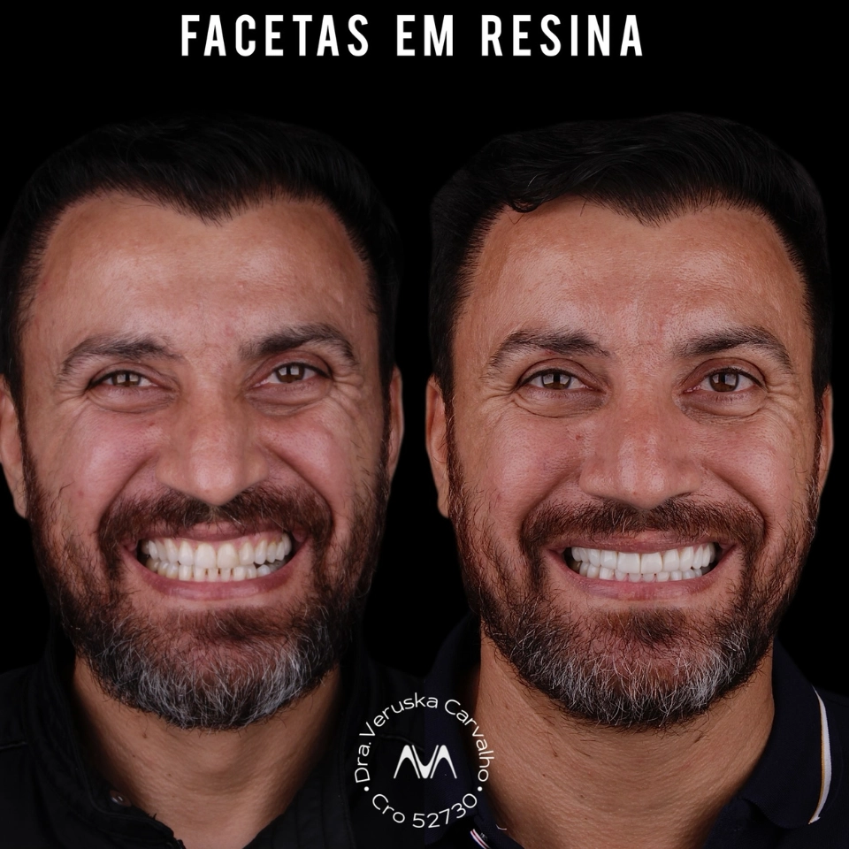 Carvalho&marino Odontologia antes e depois (11)
