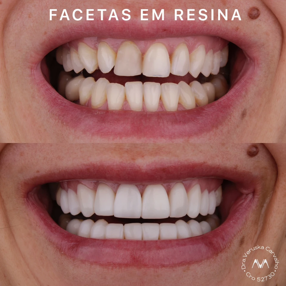 Carvalho&marino Odontologia antes e depois (12)