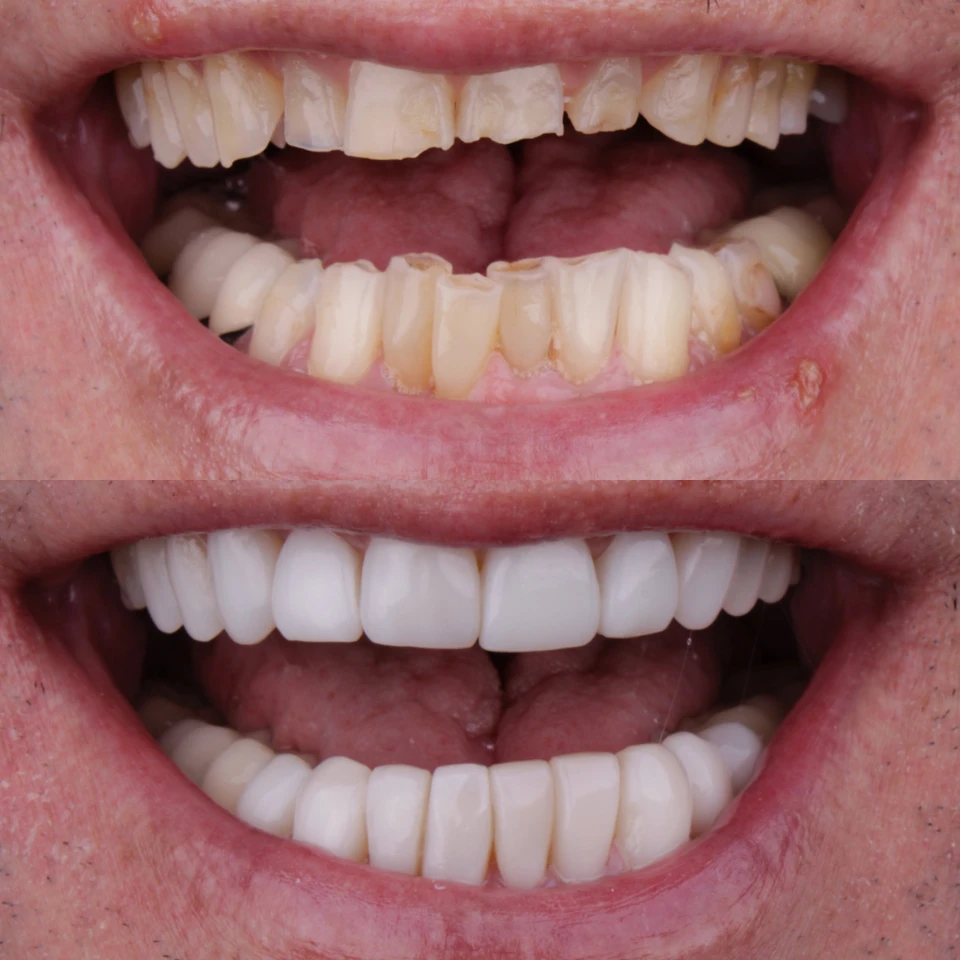 Carvalho&marino Odontologia antes e depois (2)