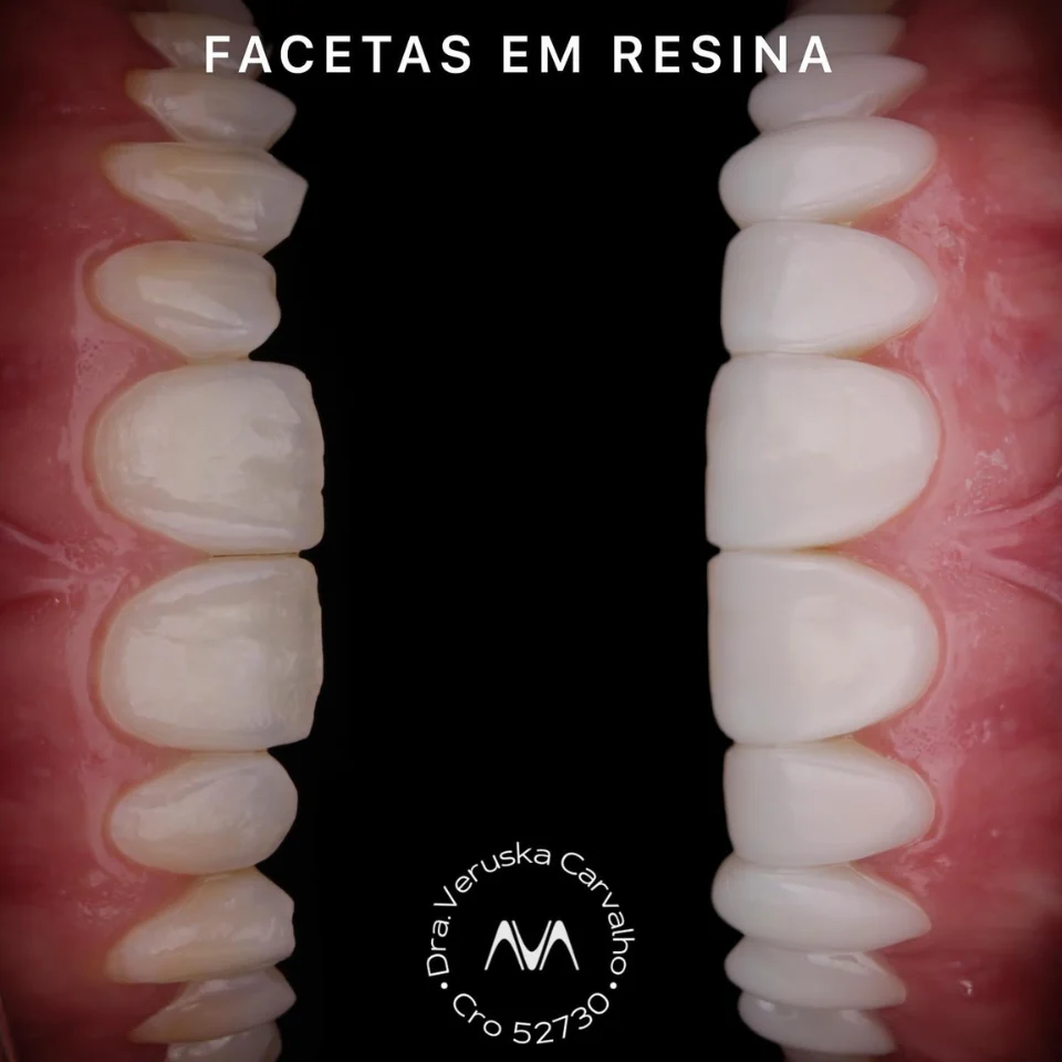 Carvalho&marino Odontologia antes e depois (3)