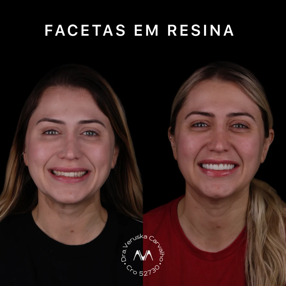 Carvalho&marino Odontologia antes e depois (6)