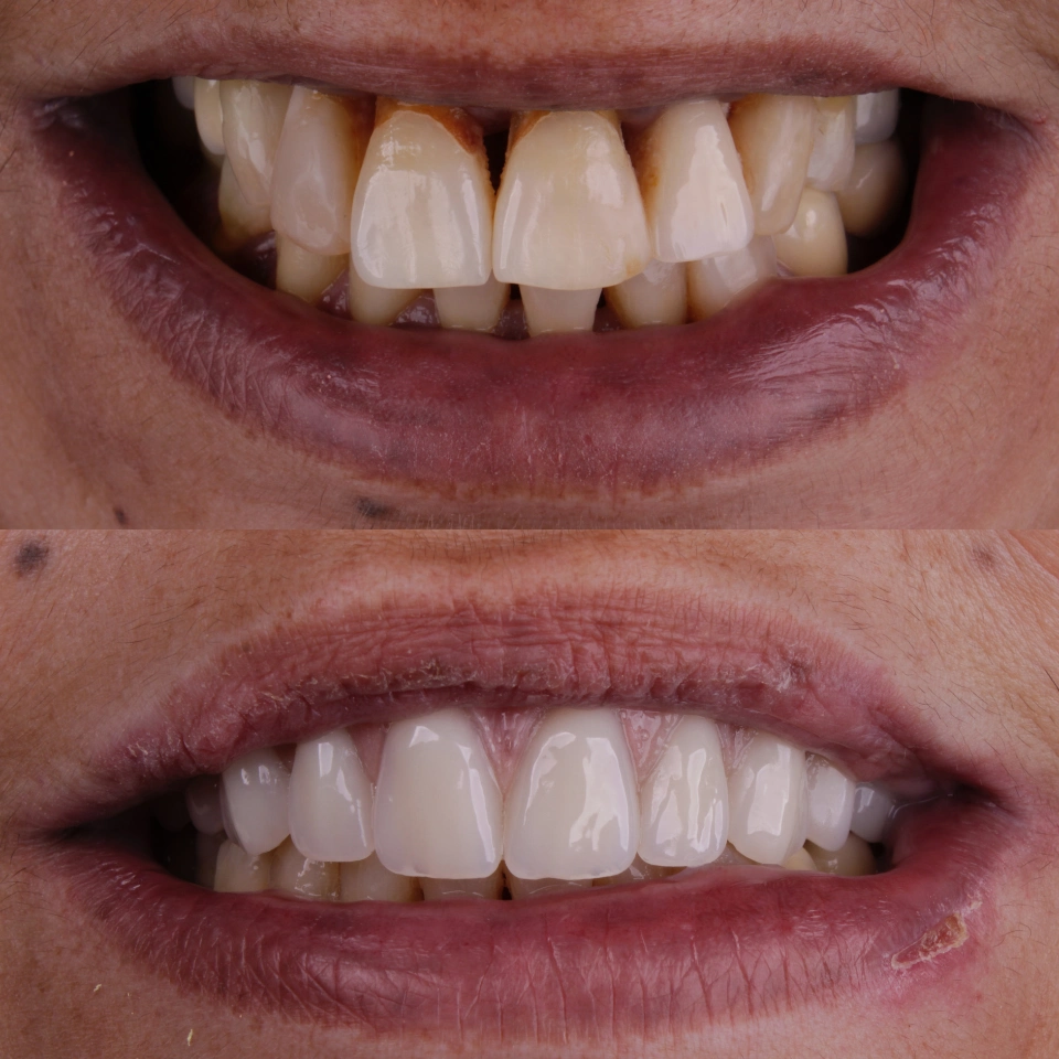 Carvalho&marino Odontologia antes e depois (7)