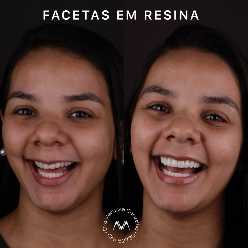 Carvalho&marino Odontologia antes e depois (8)