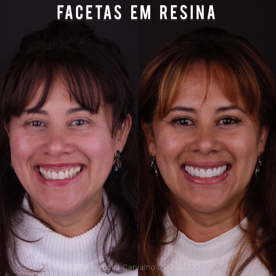 Carvalho&marino Odontologia antes e depois (9)