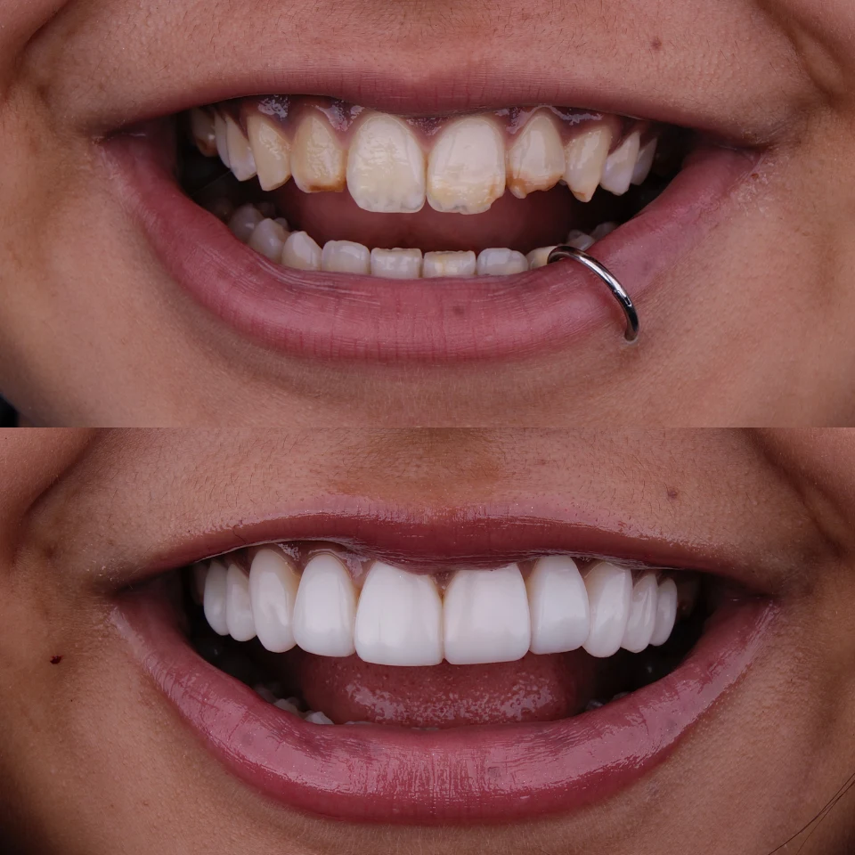 Carvalho&marino Odontologia antes e depois